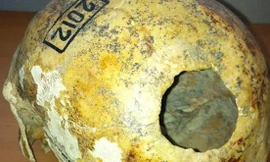 Kỳ lạ ca phẫu thuật hộp sọ cách đây 2.300 năm