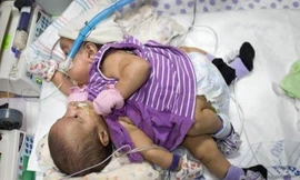 Cặp song sinh dính liền ngực Knatalye Hope và Faith Adeline Mata