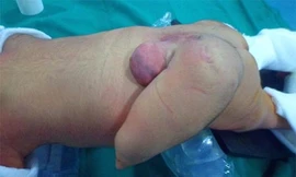 Bé sơ sinh mọc “đuôi” dài 12cm