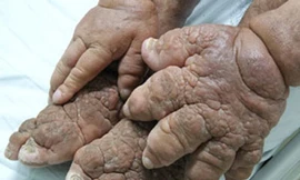 Người đàn ông có da... 'vỏ cam'