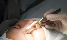 Teen Việt trong "cơn lốc" phẫu thuật thẩm mĩ