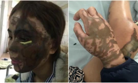 Thiếu úy công an tạt axit vào mặt vợ sắp cưới lĩnh 6 năm tù