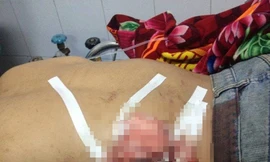 Can ngăn ẩu đả, bị dao đâm lút bụng 30cm