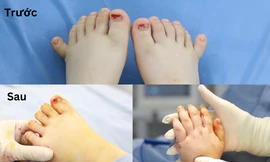 Em bé có 12 ngón tay, 12 ngón chân cực kỳ hiếm gặp