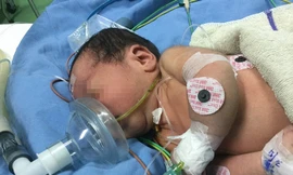 Sau ca phẫu thuật kéo dài hơn 2 tiếng, bệnh nhi đã không còn phải thở máy Ảnh BVCC