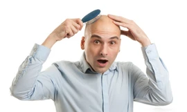 Hói đầu,bạc tóc, nỗi khổ tâm không của riêng ai 