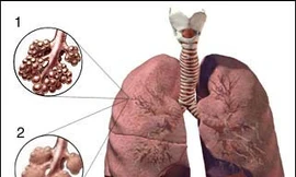 Người cao tuổi ho kéo dài, bệnh gì?