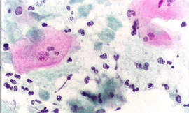 Trị viêm âm đạo do Trichomonas