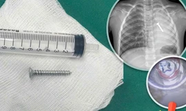 Gắp đinh vít sắc nhọn trong phổi, cứu sống bé 4 tuổi đã ngừng thở 