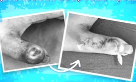 Đắp thuốc lá của thầy lang để chữa nhọt, bé trai suýt mất ngón tay