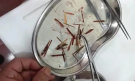 Gắp thành công 33 que nứa nằm trong mũi cô gái 18 tuổi