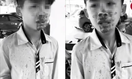 Hai học sinh mâu thuẫn, nam sinh lớp 7 bị bố bạn tát chảy máu mũi