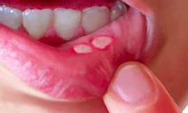Cách xử lý nhiệt miệng tại nhà cực đơn giản