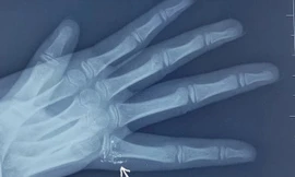 Nhiễm độc thủy ngân sẽ hại thận, phổi, não và hệ thần kinh