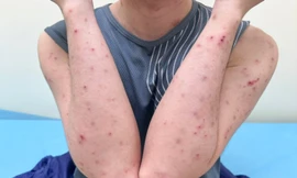 Sau mưa lũ, cẩn thận với các bệnh về da