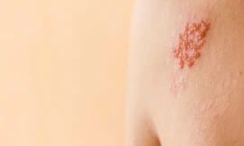 Bệnh Zona thần kinh đang ngày càng trẻ hóa, dễ bị nhầm với tai biến