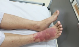 Những ai dễ bị lây bệnh liên cầu lợn?