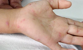 Hơn 87 nghìn người mắc bệnh chân tay miệng