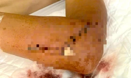 Truy tố giám đốc công ty xây dựng dùng kiếm chém thợ sắt nhập viện