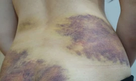 Vết thương của chị S bị chồng bạo hành