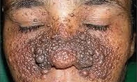 Những hình ảnh đáng sợ của ung thư da