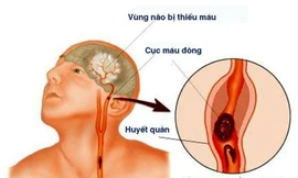 Chàng trai 23 tuổi phải nhập viện vì căn bệnh thường gặp ở người già