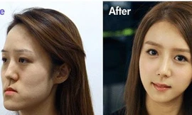 Cô gái Hàn xấu xí bỗng xinh như thiên thần nhờ... phẫu thuật