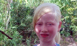 Lạ kỳ cô bé người Khmer trắng như tuyết