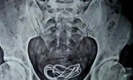 Bệnh nhân khai trót “ăn” dây sạc điện thoại, nhưng bác sĩ lại tìm thấy trong bàng quang
