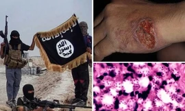 Cận cảnh những vết lở loét của binh lính IS. Ảnh: The Sun 
