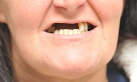 Người phụ nữ bay mất nửa hàm răng vì ham rẻ