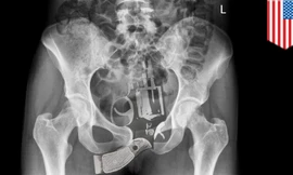 Cô gái bị phát hiện giấu súng vào... vùng kín 