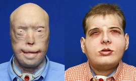 Trước và sau khi phẫu thuật 