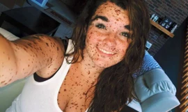 Cô gái tự tin mặc bikini dù có hơn... 100 vết bớt