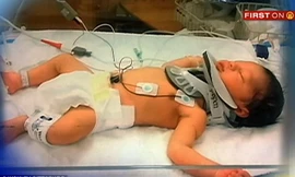 Bé sơ sinh chấn thương sọ não vì bị y tá đánh rơi