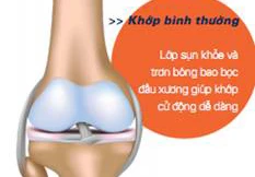 Cần biết về điều trị thoái hóa khớp