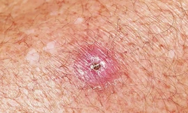 Sự bùng phát ổ dịch ăn thịt ở Úc, loét Buruli.