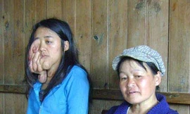 Hai phụ nữ trẻ mắc bệnh “lạ”