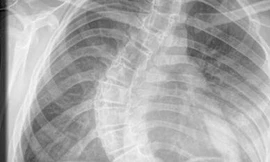 Bé gái bị vẹo xương sống một góc 90 độ