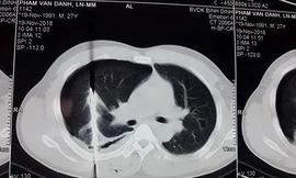 Kết quả chụp phim của bệnh nhân. Ảnh: Bệnh viện cung cấp