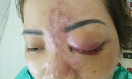 Nữ bệnh nhân bị mù mắt sau 5 phút tiêm filler.