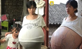 Người phụ nữ gây sốc vì bụng phình khổng lồ suốt 2 năm không rõ nguyên nhân