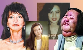 Những ‘thảm họa dao kéo’ của showbiz châu Á