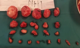 Vừa mổ lấy thai, vừa 'bóc' hàng chục khối u cho sản phụ 27 tuổi