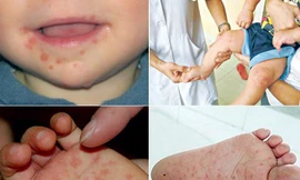 Dịch chân tay miệng có chiều hướng tăng cao
