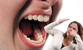 Mẹo giúp chữa hôi miệng hiệu quả