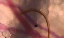 Rợn người cảnh muỗi huơ vòi hút máu dưới da