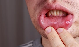 Bác sĩ cảnh báo những bệnh có thể lây khi quan hệ tình dục bằng miệng