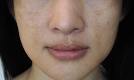 Nám da, những điều có thể bạn chưa biết 