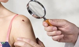 Sự thay đổi đột ngột về màu sắc, hình dạng hoặc kích thước của mụn cơm hoặc nốt ruồi trên da là dấu hiệu phổ biến của ung thư. Ảnh minh họa: Health.